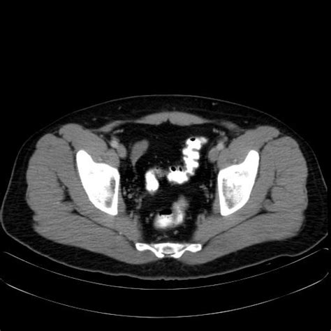 Image result for Testicles Surgery