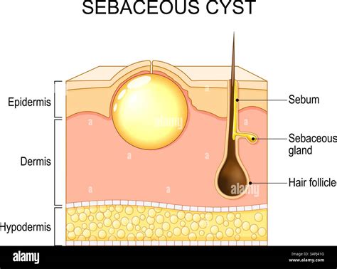 Exploding Cyst Core に対する画像結果