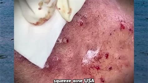 Image result for Exploding Back Pimples