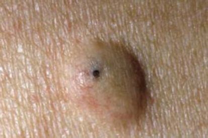 Exploding Cyst Core に対する画像結果