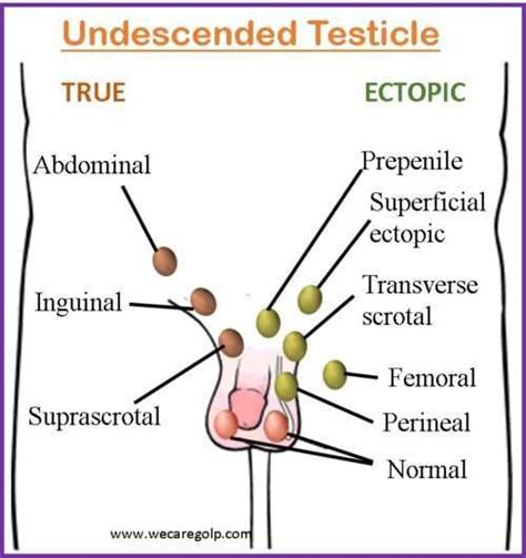 Image result for Testicles Surgery