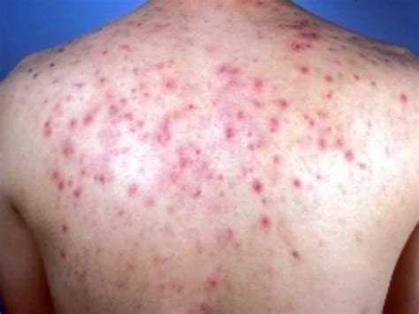 Image result for Exploding Back Pimples