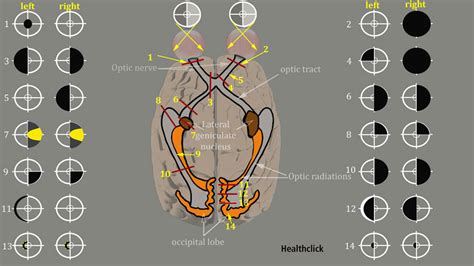 Vestibular Rehab CEU - Oculomotor Dysfunction and Tracking Exercises