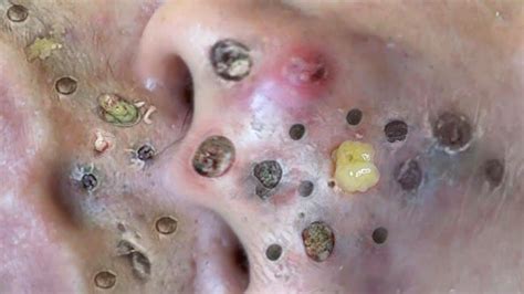 Image result for Exploding Back Pimples