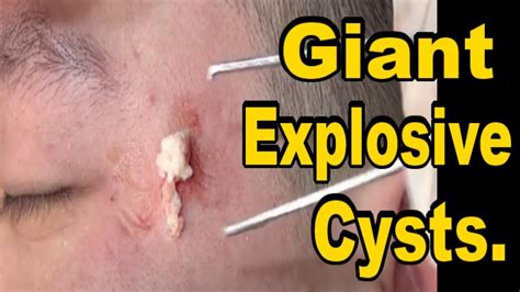 Exploding Cyst Core に対する画像結果