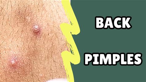 Image result for Exploding Back Pimples