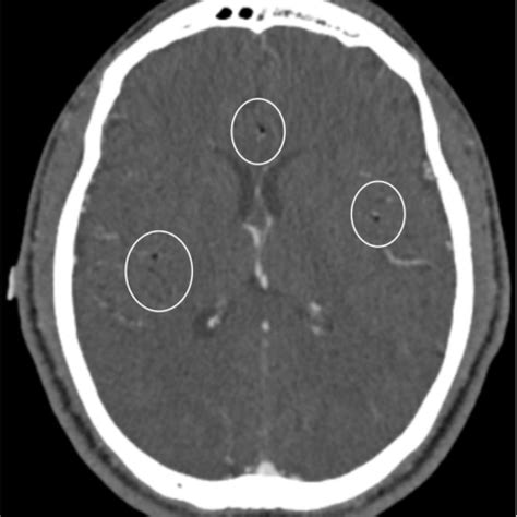 Exploding Cyst Core に対する画像結果