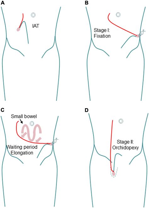 Image result for Testicles Surgery