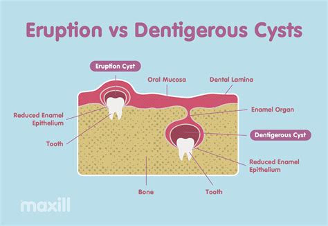 Exploding Cyst Core に対する画像結果