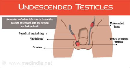 Image result for Testicles Surgery