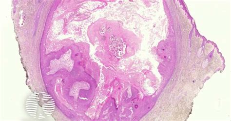 Exploding Cyst Core に対する画像結果