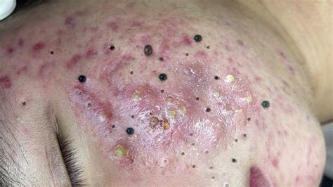 Image result for Exploding Back Pimples