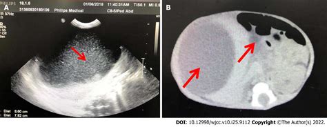 Exploding Cyst Core に対する画像結果