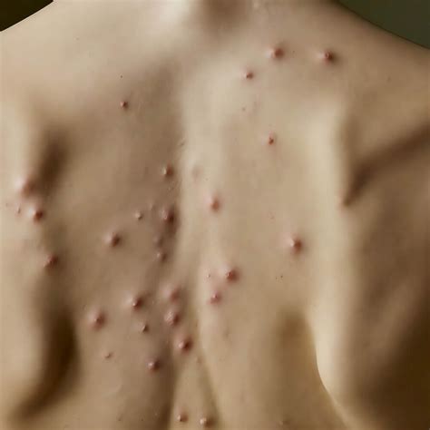 Image result for Exploding Back Pimples