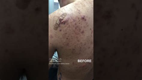 Image result for Exploding Back Pimples