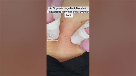Image result for Exploding Back Pimples