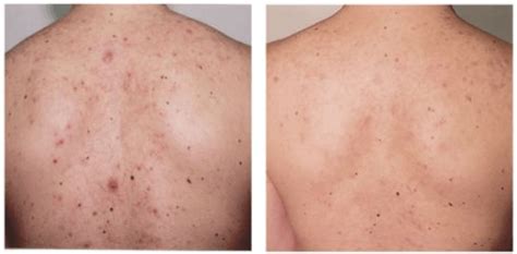 Image result for Exploding Back Pimples