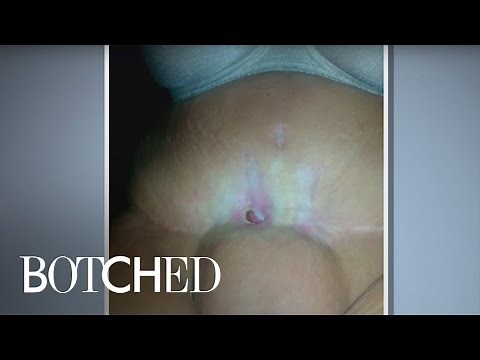 "Botched" Doctors Tackle an Alien Stomach! | E!