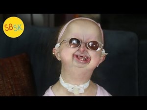 Life with One of the World’s Rarest Syndromes (Hallerman-Streiff)