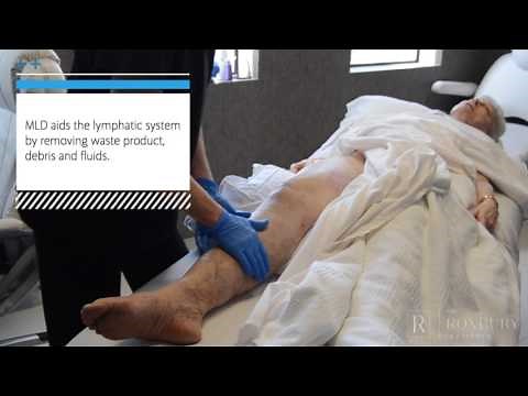 Manual Lymphatic Drainage (MLD) Post-Lipedema Surgery