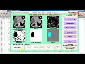 Liver Cancer Detection Using Image Processing Matlab Project Source Code