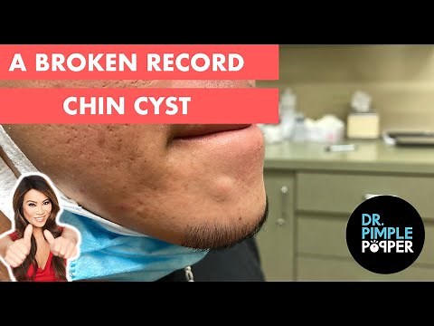 A Broken Record Cyst