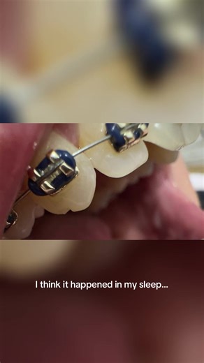 Experiencing Tooth Chips with Braces: What to Know