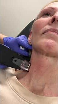 New Morpheus8 Resurfacing Tip for Even BETTER Results