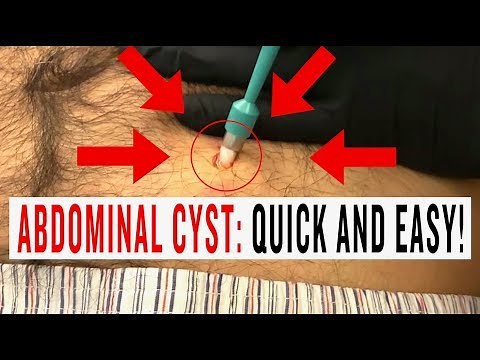 ABDOMINAL CYST: QUICK AND EASY!