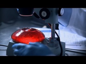 Breast Implant Infection - Monsters Inside Me Ep5