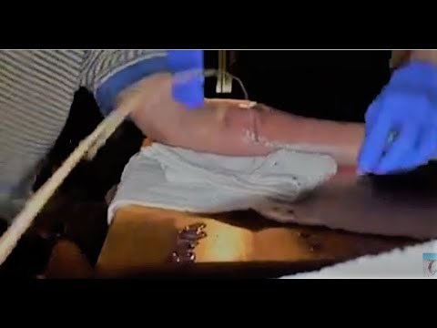 Cyst Abscess Pus Draining From Arm Explodes Educational