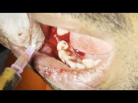 Explosive Dental abscess drainage and tooth extraction | Live On Patient