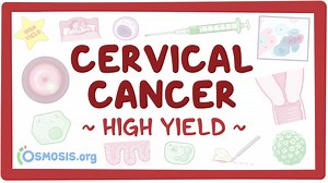 Cervical cancer: Pathology review: Video, Causes, & Meaning | Osmosis