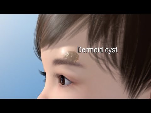 Dermoid Cyst Ablation