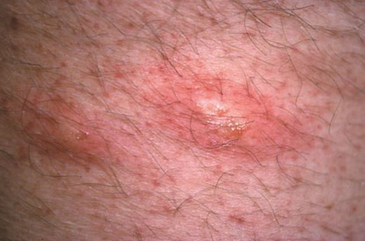 Scrotum Rash Causes, Symptoms, Itchy, White Rash, STD, Red Heat Rash, Pictures Treatment – Treat MD