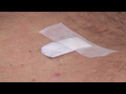 How to Take Care of Your Excision or Mohs Surgery Site