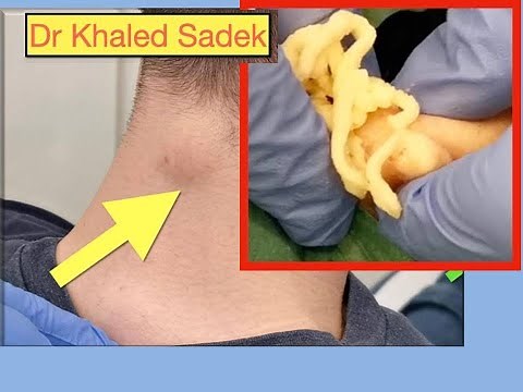 Neck Cyst. Dr Khaled Sadek