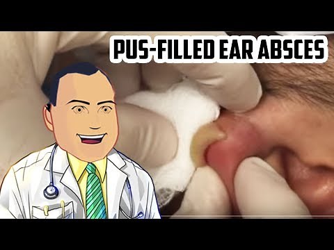Pus-Filled Ear Abscess Drained - Revisited Popping