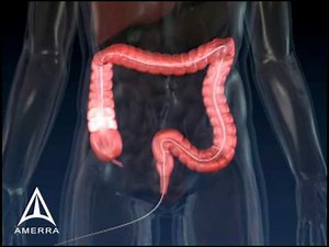 Colonoscopy - 3D Medical Animation