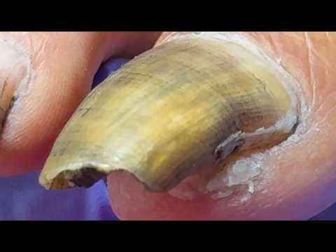 My Toenails Are Too Long And Curly, Cut Those Dirty Nails!【Xue Yidao】