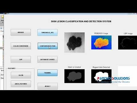 Skin Cancer Detection Using Matlab