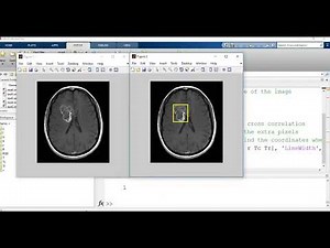 Template matching : Image processing and computer vision application in matlab (medical application)