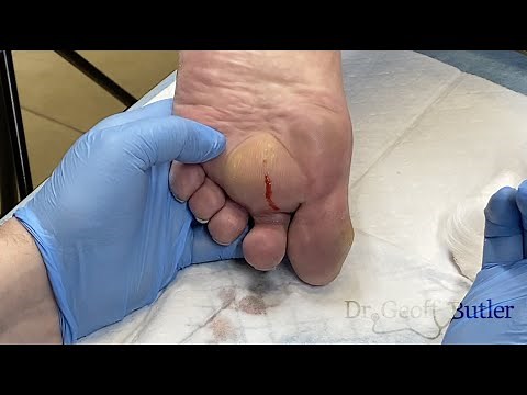 Unexpected drainage of an abscess on the foot