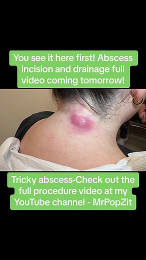 Cyst and Abscess Incision and Drainage Procedure