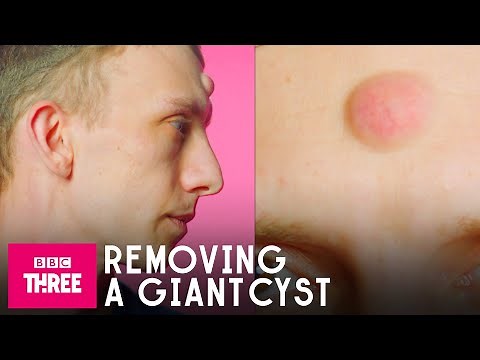 Removing A Giant Cyst: Skin
