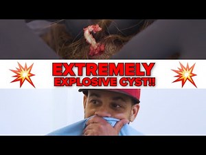 EXTREMELY EXPLOSIVE CYST!!!