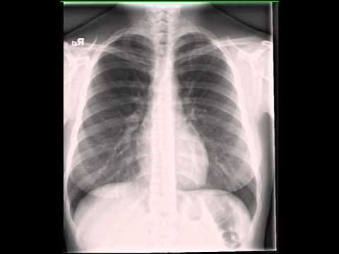 Normal Chest X ray