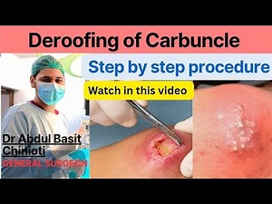 Excision of carbuncle,deroofing of the carbuncle,A,carbuncle and its Treatment,پقندر پھوڑا کا علاج