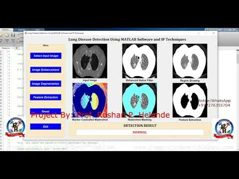 Lung Cancer Detection Using Watershed Segmentation and CNN | Lung Cancer Prediction Machine Learning