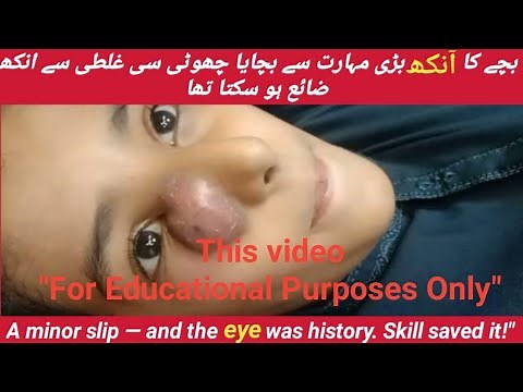 Huge Abscess Drain on Child Face